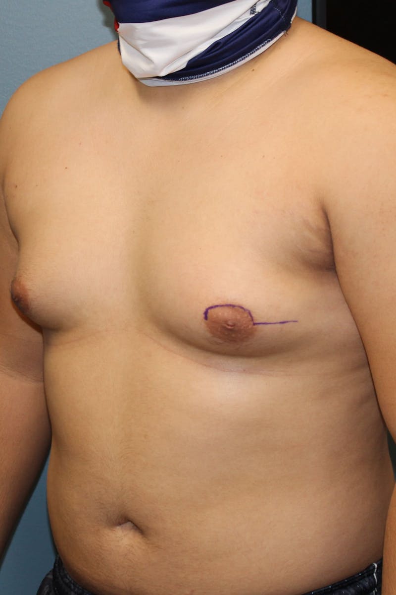 Gynecomastia Before & After Gallery - Patient 109285 - Image 3