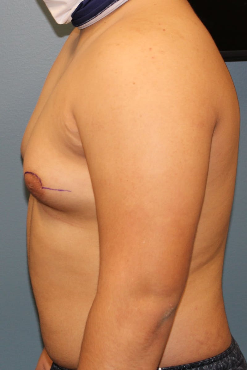 Gynecomastia Before & After Gallery - Patient 109285 - Image 5