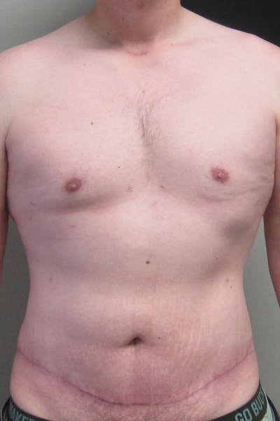Gynecomastia Before & After Gallery - Patient 232492 - Image 2