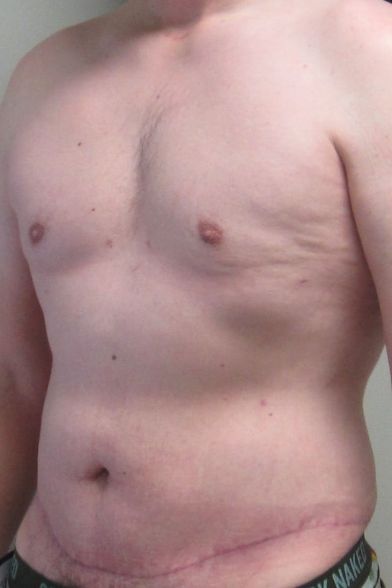 Gynecomastia Before & After Gallery - Patient 232492 - Image 4