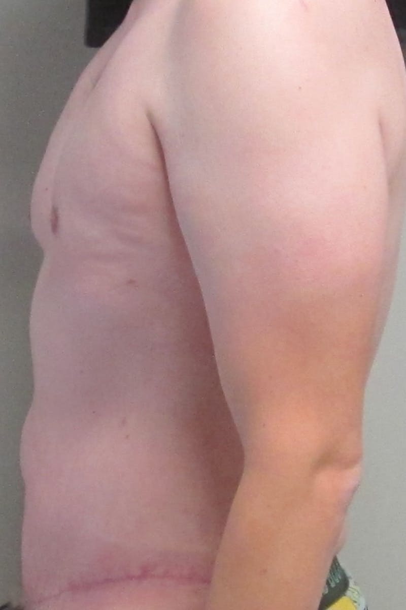 Gynecomastia Before & After Gallery - Patient 232492 - Image 6