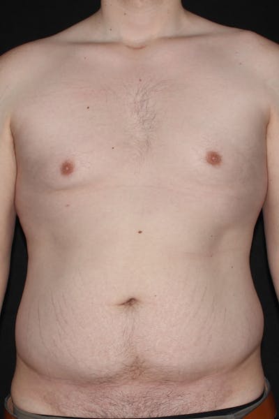 Gynecomastia Before & After Gallery - Patient 232492 - Image 1