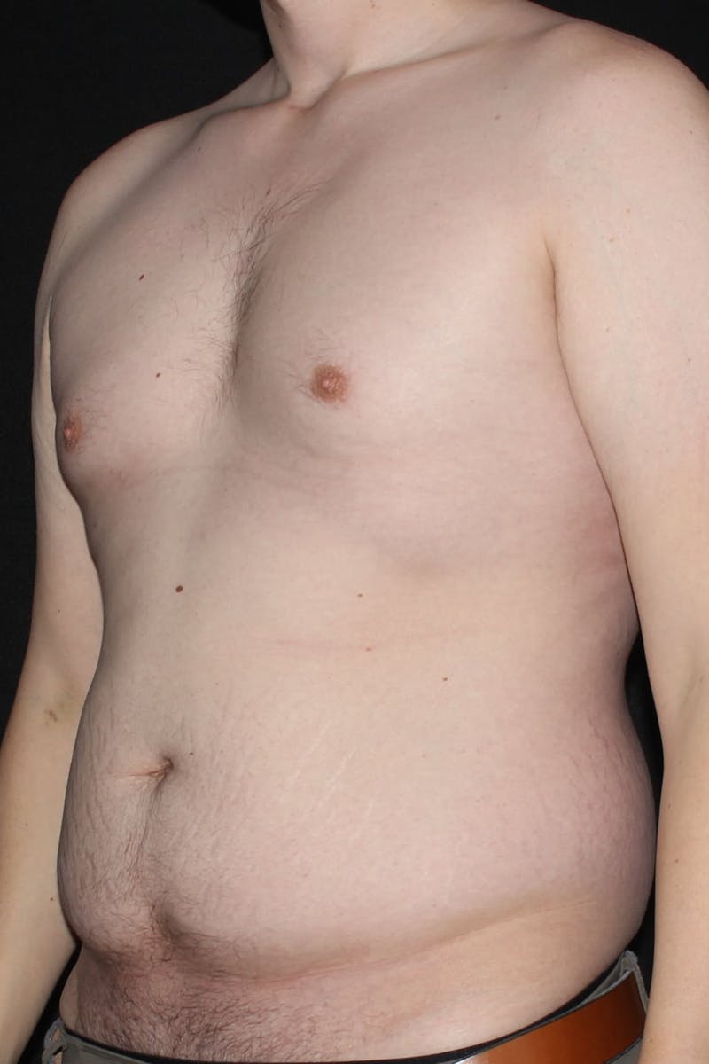 Gynecomastia Before & After Gallery - Patient 232492 - Image 3