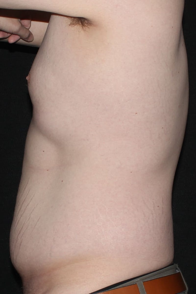 Gynecomastia Before & After Gallery - Patient 232492 - Image 5