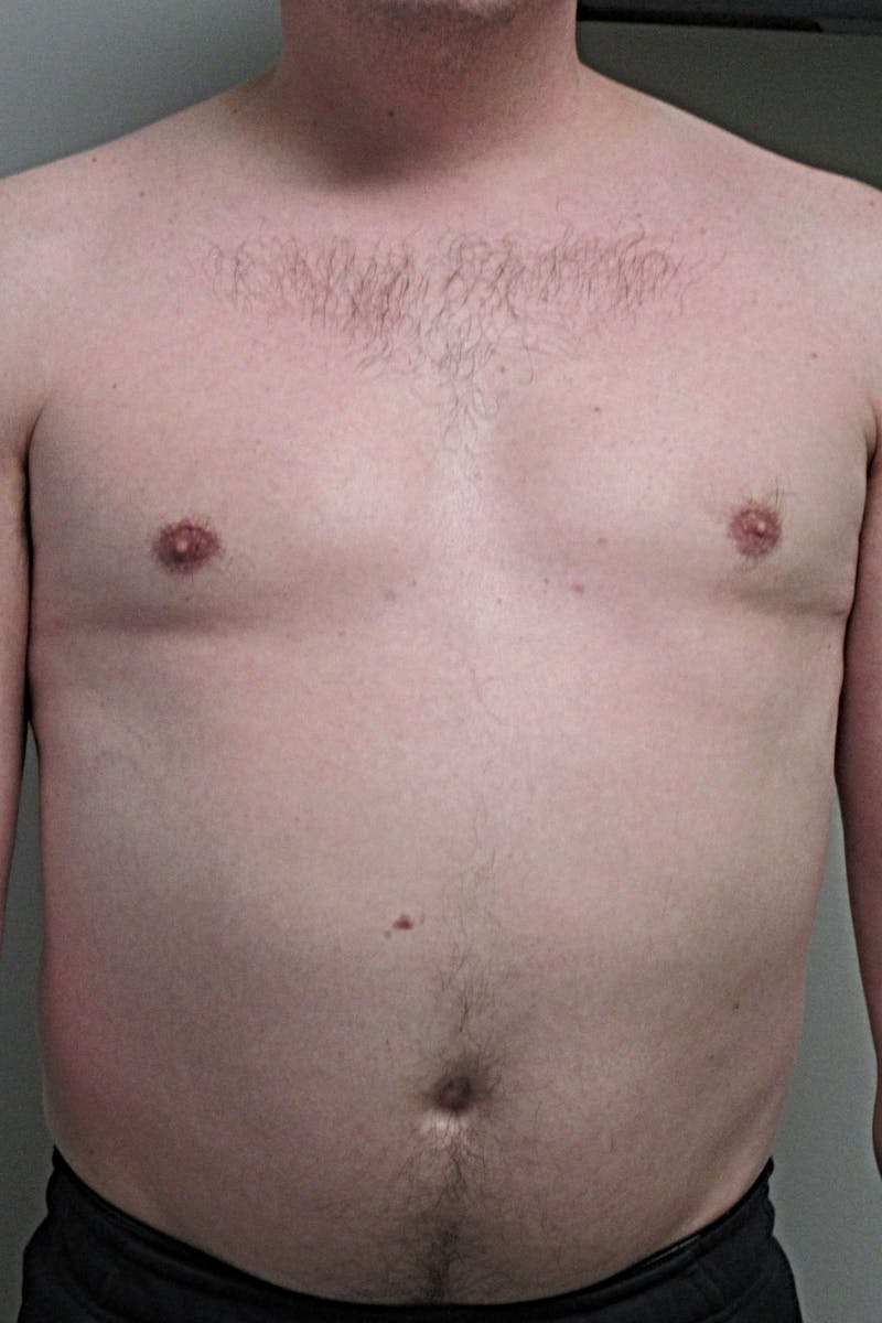 Gynecomastia Before & After Gallery - Patient 298506 - Image 2