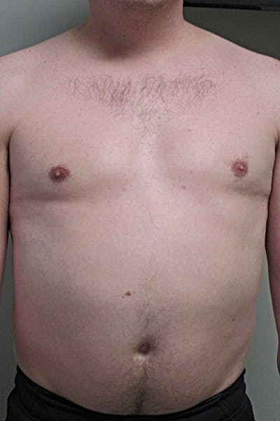 Gynecomastia Before & After Gallery - Patient 298506 - Image 2
