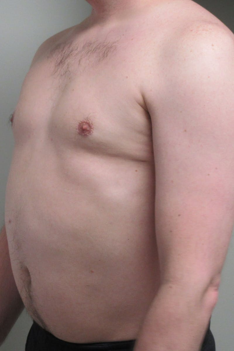 Gynecomastia Before & After Gallery - Patient 298506 - Image 4