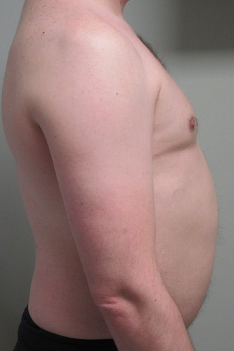 Gynecomastia Before & After Gallery - Patient 298506 - Image 6
