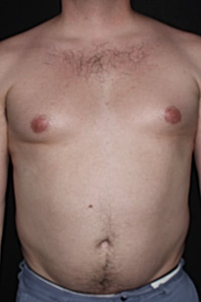 Gynecomastia Before & After Gallery - Patient 298506 - Image 1