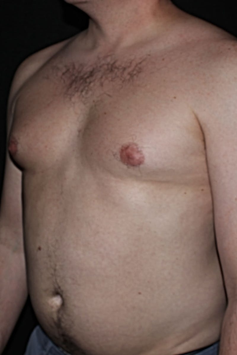 Gynecomastia Before & After Gallery - Patient 298506 - Image 3