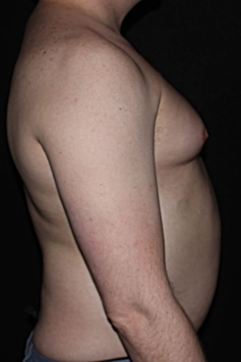 Gynecomastia Before & After Gallery - Patient 298506 - Image 5