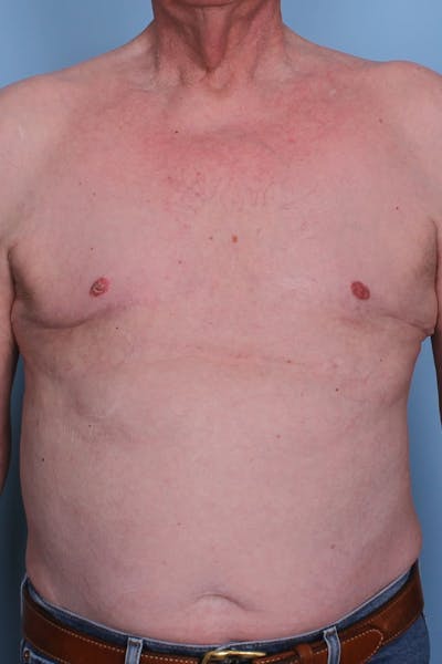 Gynecomastia Before & After Gallery - Patient 296556 - Image 1