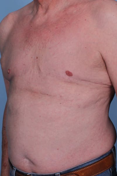 Gynecomastia Before & After Gallery - Patient 296556 - Image 2