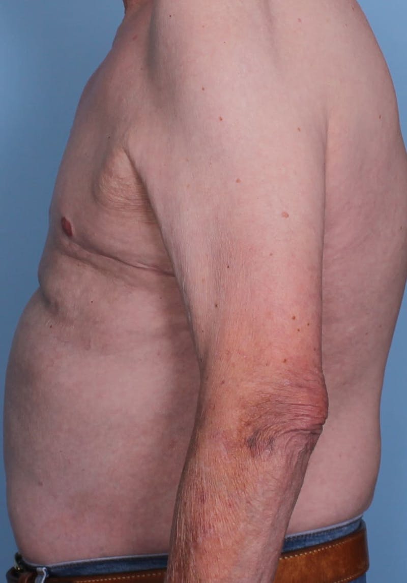 Gynecomastia Before & After Gallery - Patient 296556 - Image 3