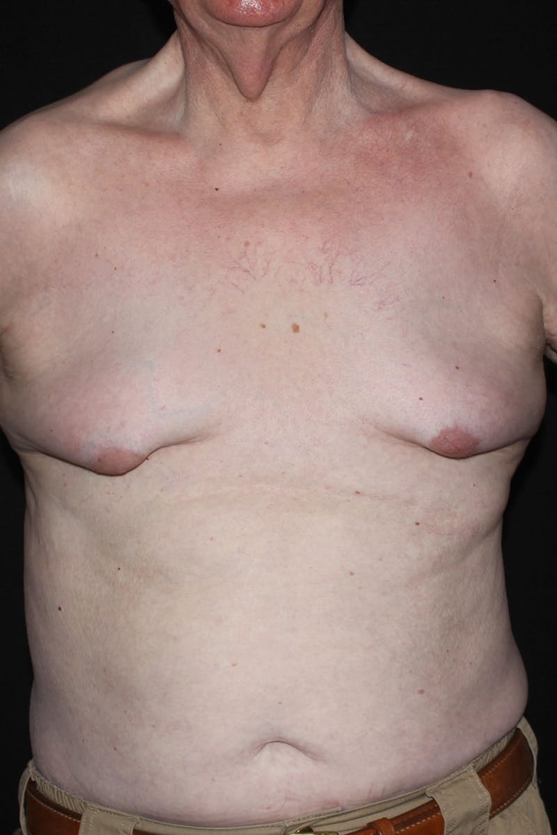 Gynecomastia Before & After Gallery - Patient 296556 - Image 4
