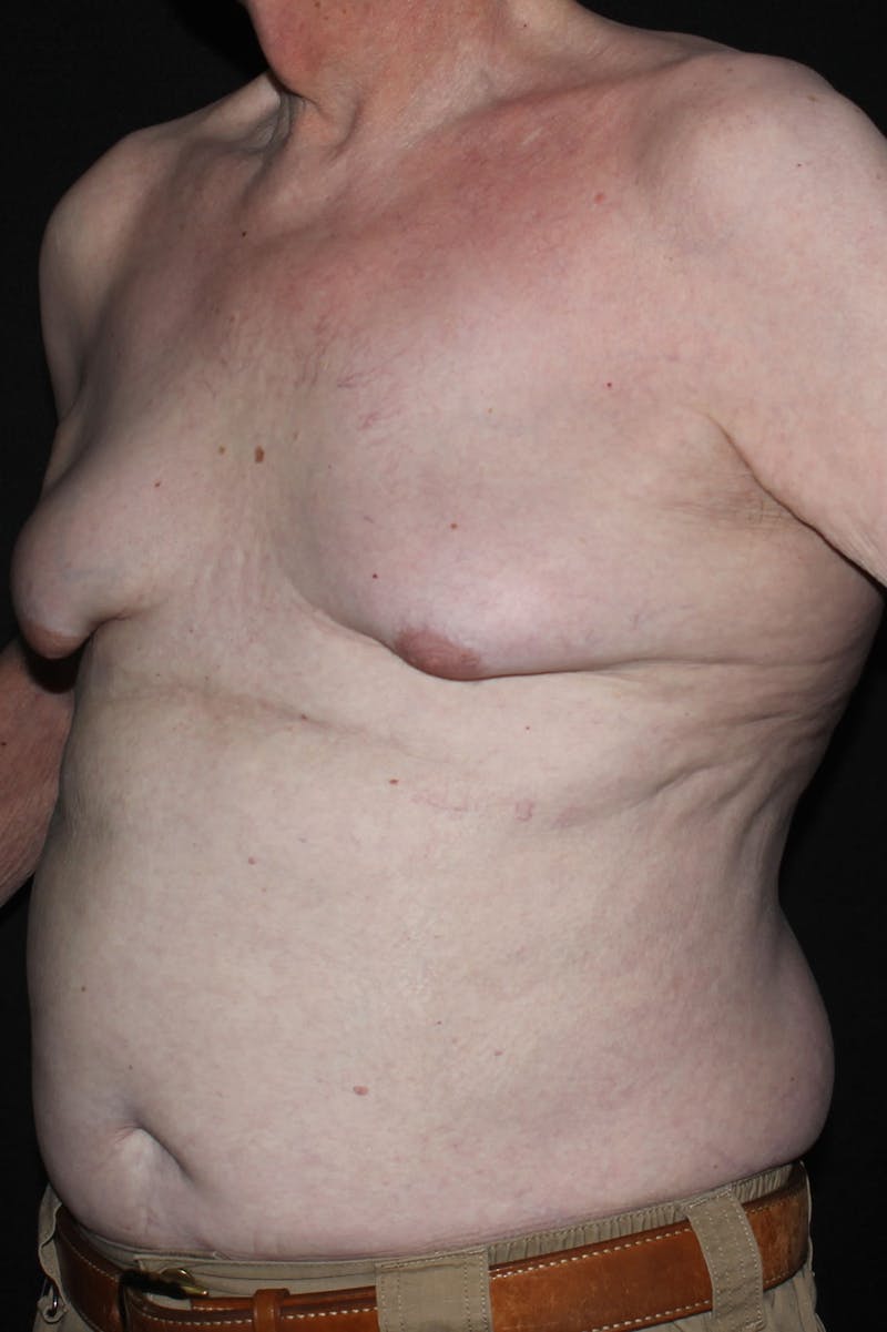 Gynecomastia Before & After Gallery - Patient 296556 - Image 5