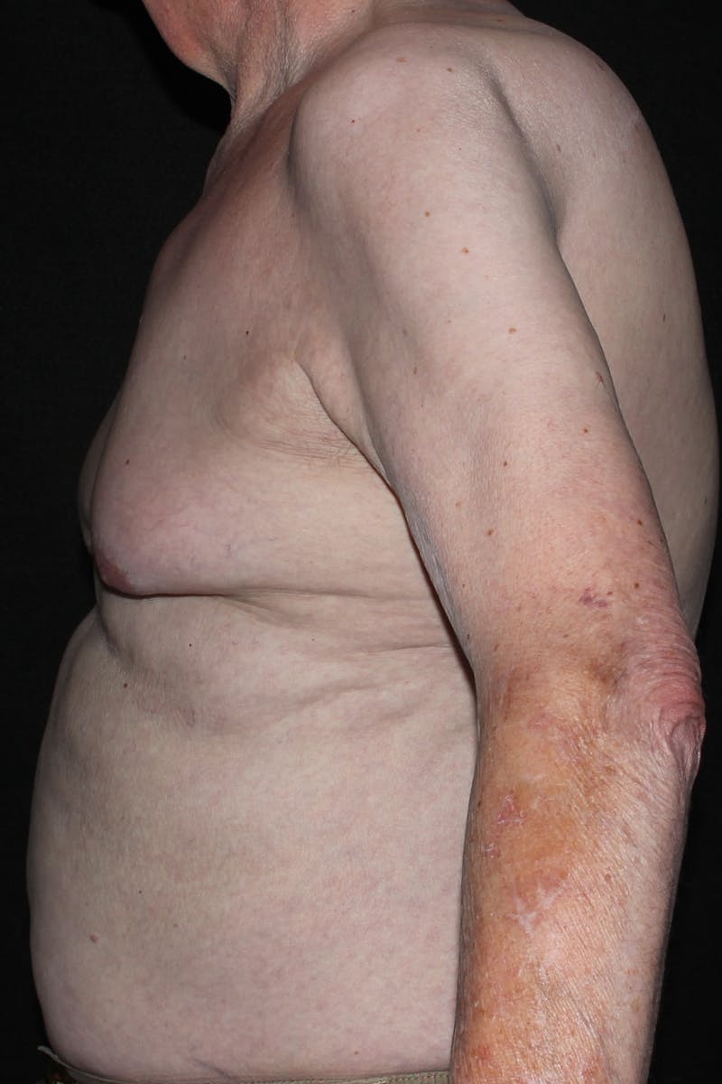 Gynecomastia Before & After Gallery - Patient 296556 - Image 6