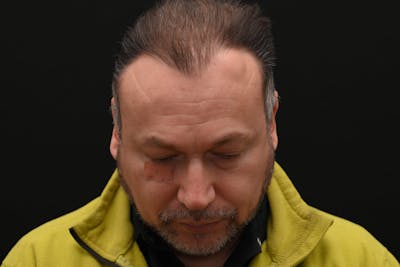 Facial Lesion/Keloid Removal Before & After Gallery - Patient 201183 - Image 1