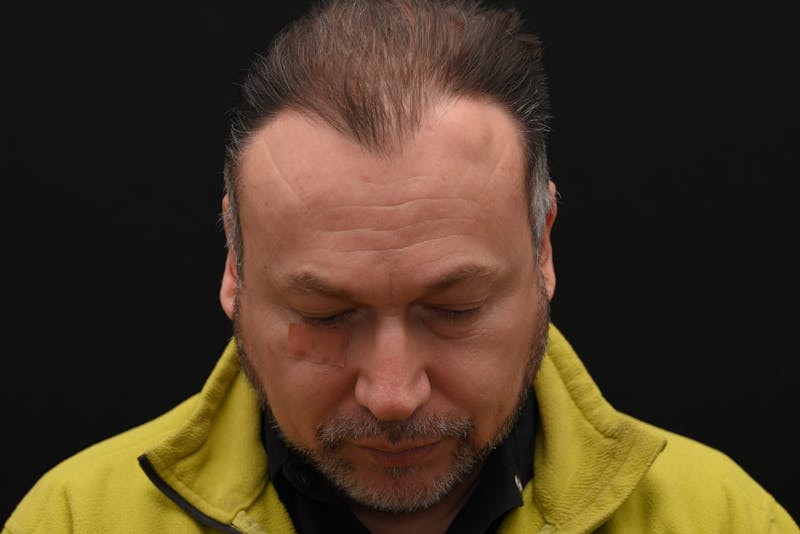 Facial Lesion Excision/Lipoma/Keloid Removal Before & After Gallery - Patient 201183 - Image 1