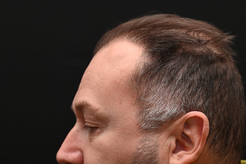 Facial Lesion Excision/Lipoma/Keloid Removal Before & After Gallery - Patient 201183 - Image 7