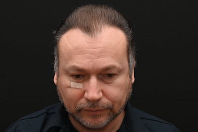 Facial Lesion/Keloid Removal Before & After Gallery - Patient 201183 - Image 2