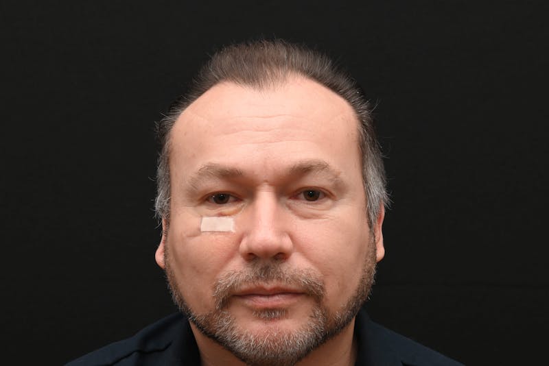 Facial Lesion Excision/Lipoma/Keloid Removal Before & After Gallery - Patient 201183 - Image 4