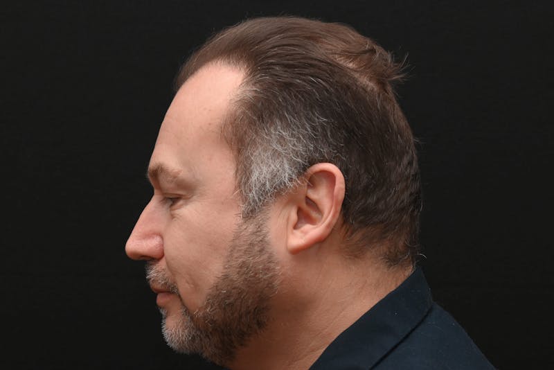Facial Lesion Excision/Lipoma/Keloid Removal Before & After Gallery - Patient 201183 - Image 8