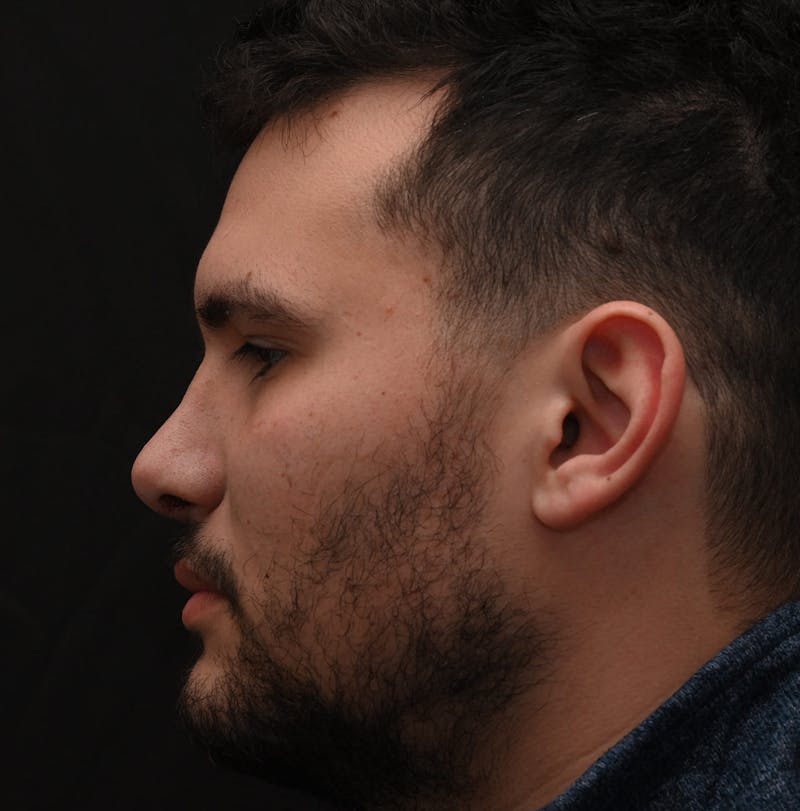Rhinoplasty Before & After Gallery - Patient 296658 - Image 6