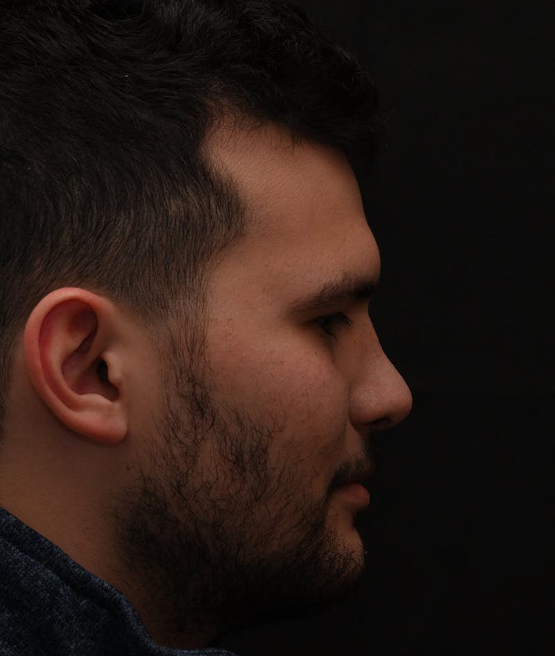 Rhinoplasty Before & After Gallery - Patient 296658 - Image 8