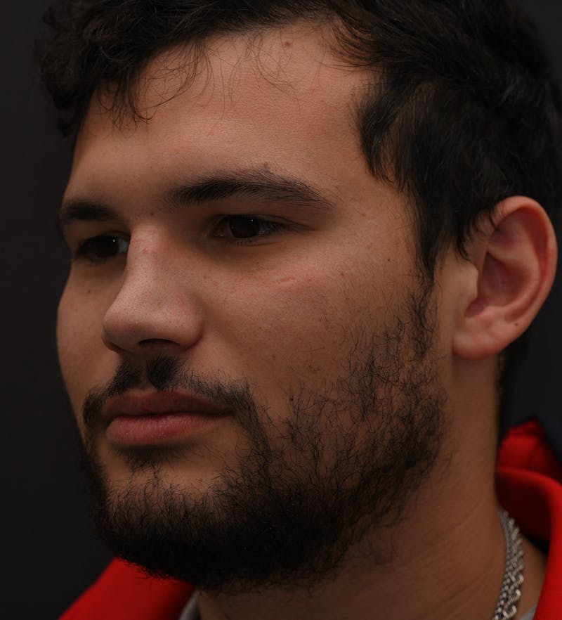 Rhinoplasty Before & After Gallery - Patient 296658 - Image 9