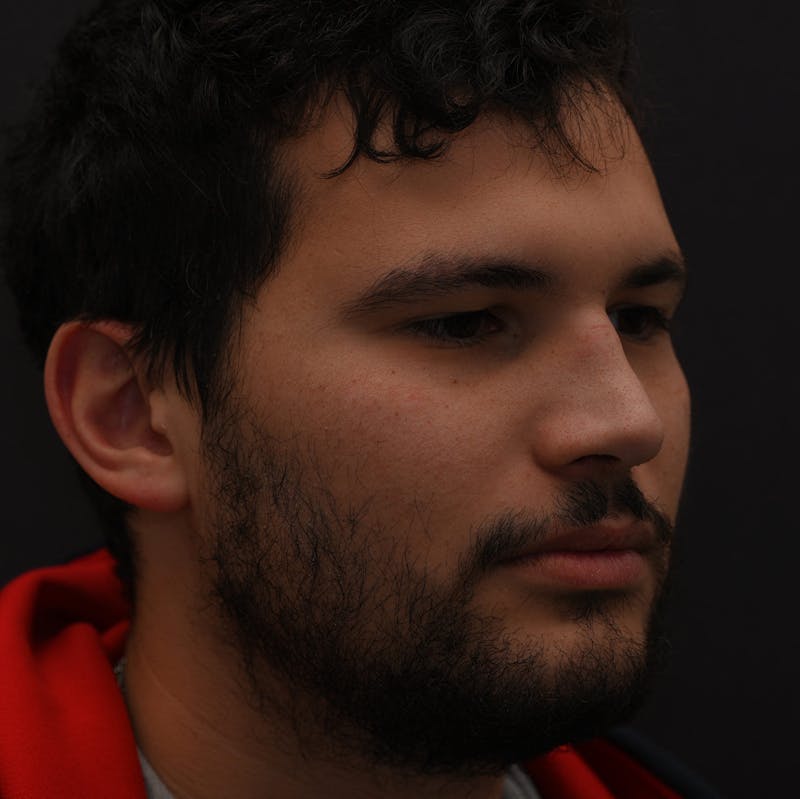Rhinoplasty Before & After Gallery - Patient 296658 - Image 1