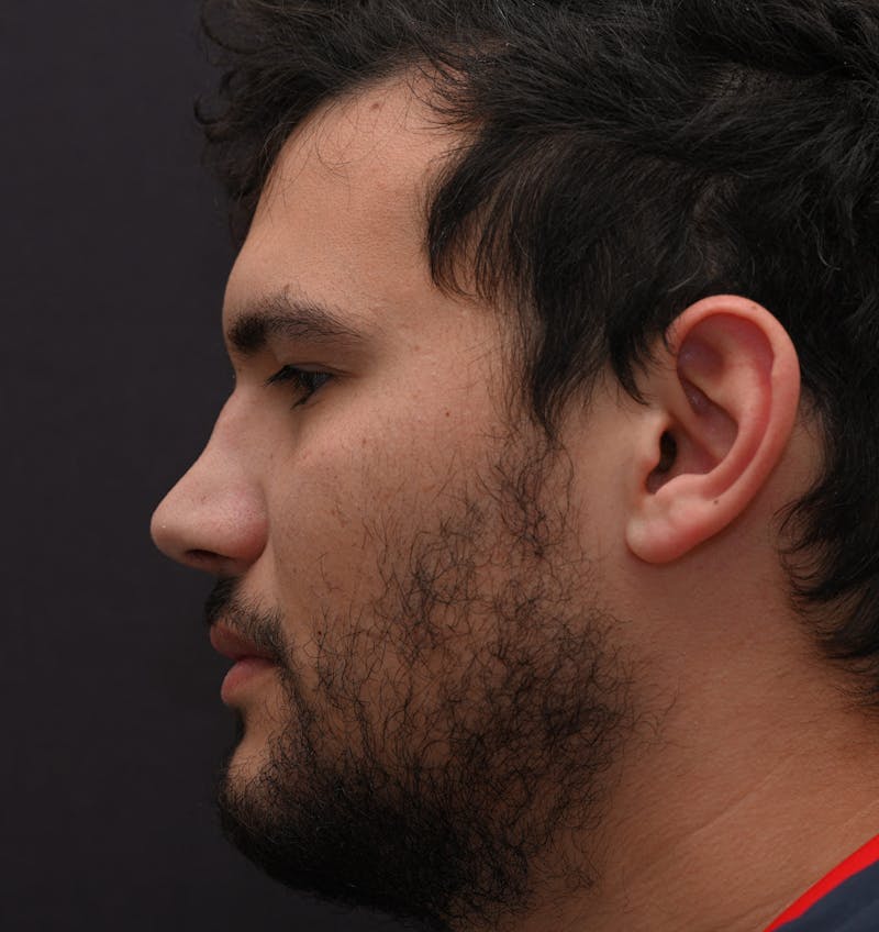 Rhinoplasty Before & After Gallery - Patient 296658 - Image 5