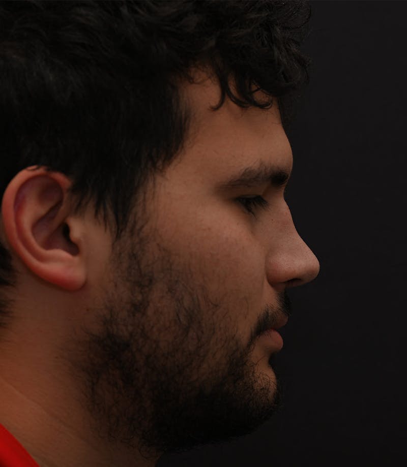 Rhinoplasty Before & After Gallery - Patient 296658 - Image 7
