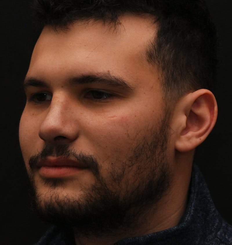 Rhinoplasty Before & After Gallery - Patient 296658 - Image 10