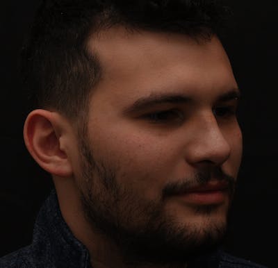 Rhinoplasty Before & After Gallery - Patient 296658 - Image 2