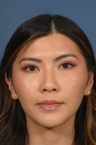 Facial Lesion/Keloid Removal Before & After Gallery - Patient 197503 - Image 1