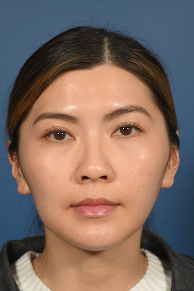 Facial Lesion/Keloid Removal Before & After Gallery - Patient 197503 - Image 2