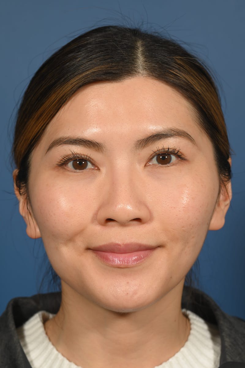 Facial Lesion Excision/Lipoma/Keloid Removal Before & After Gallery - Patient 197503 - Image 4