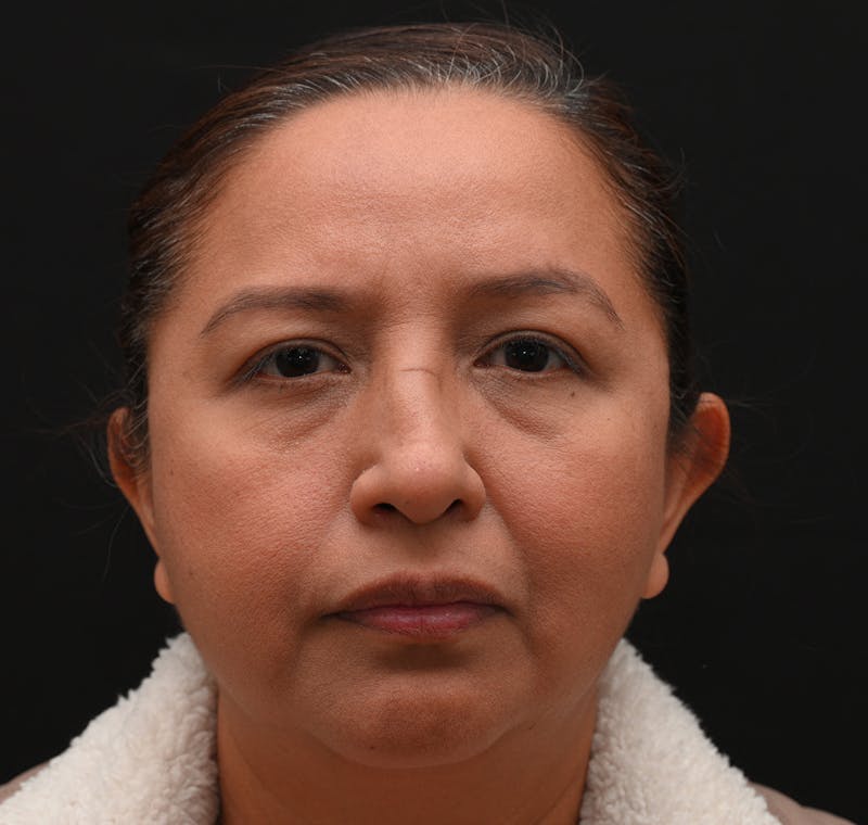 Rhinoplasty Before & After Gallery - Patient 244543 - Image 5