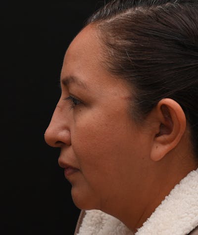 Rhinoplasty Before & After Gallery - Patient 244543 - Image 1
