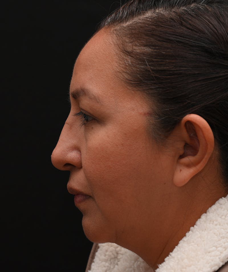 Rhinoplasty Before & After Gallery - Patient 244543 - Image 1