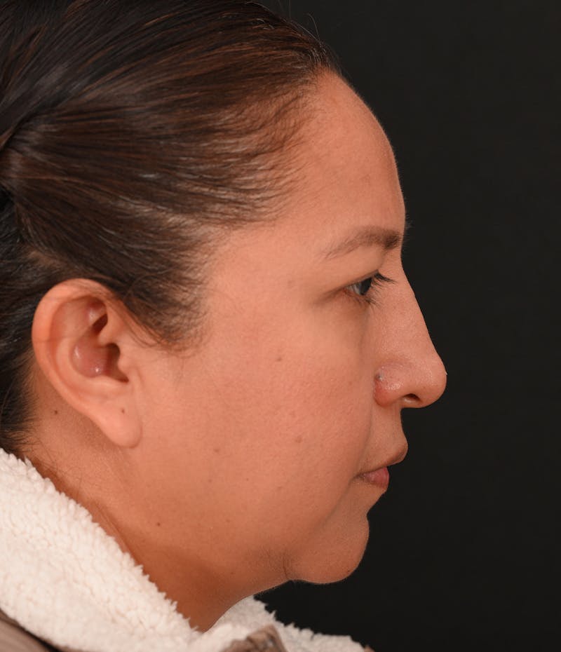 Rhinoplasty Before & After Gallery - Patient 244543 - Image 3