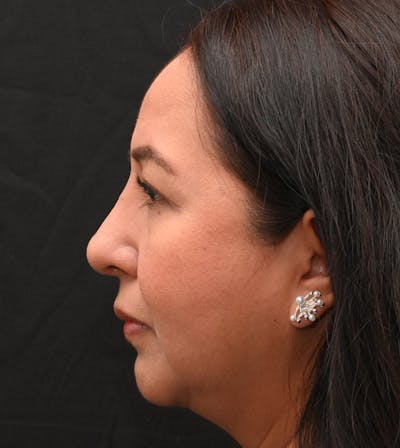 Rhinoplasty Before & After Gallery - Patient 244543 - Image 2