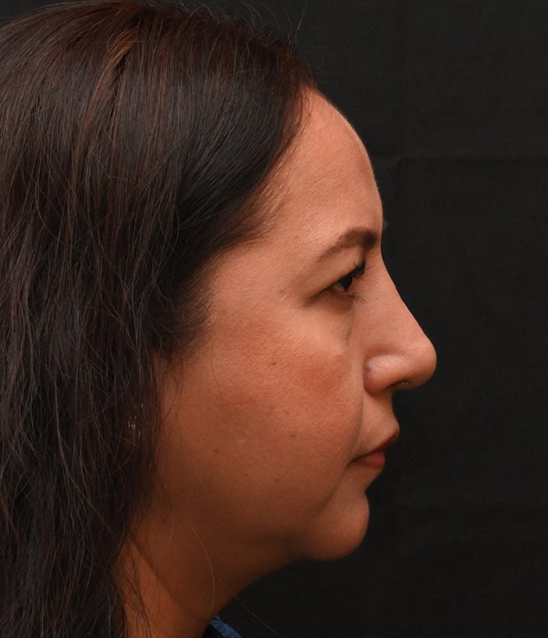 Rhinoplasty Before & After Gallery - Patient 244543 - Image 4