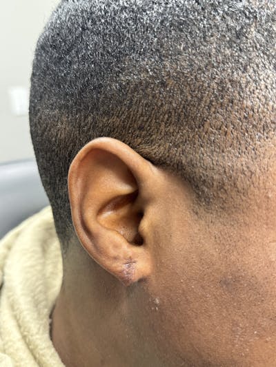 Facial Lesion/Keloid Removal Before & After Gallery - Patient 311175 - Image 2