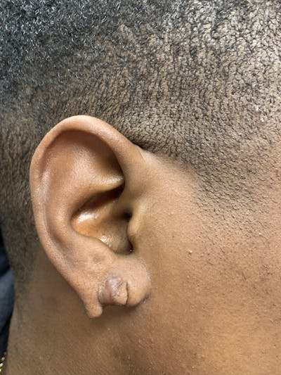 Facial Lesion/Keloid Removal Before & After Gallery - Patient 311175 - Image 1