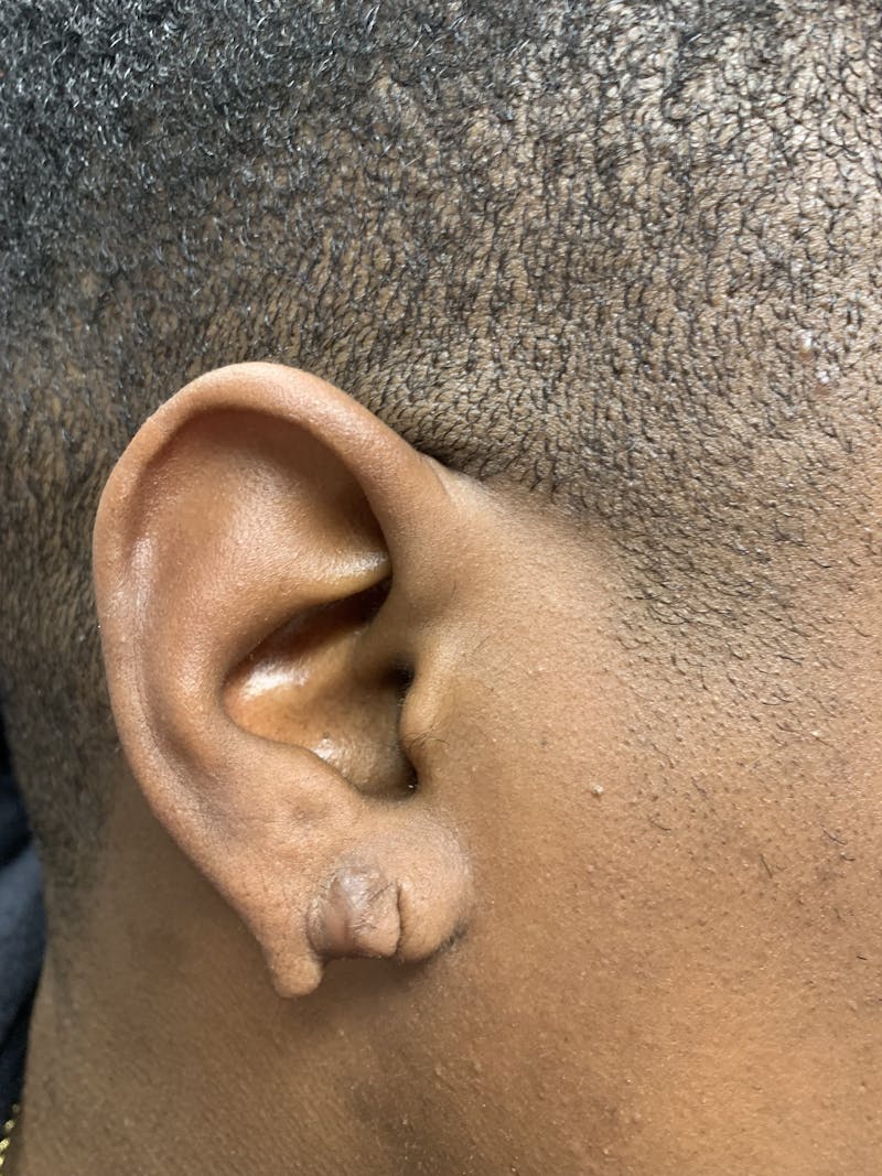 Facial Lesion Excision/Lipoma/Keloid Removal Before & After Gallery - Patient 311175 - Image 1