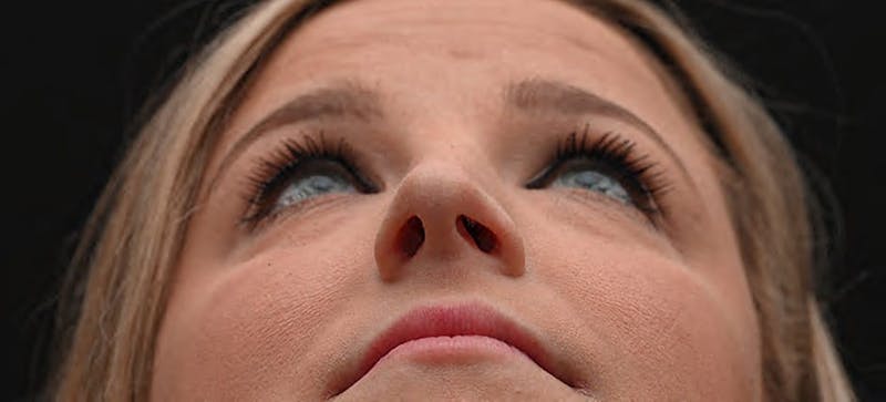 Rhinoplasty Before & After Gallery - Patient 212758 - Image 7