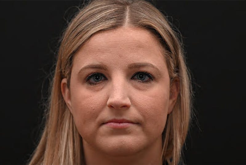 Rhinoplasty Before & After Gallery - Patient 212758 - Image 5