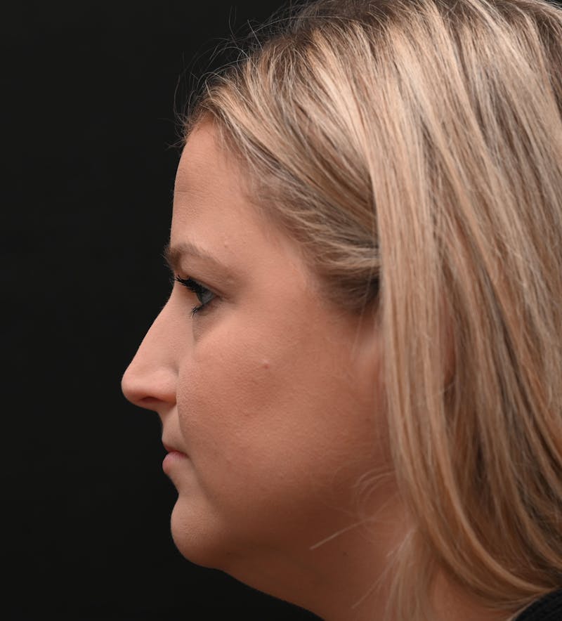 Rhinoplasty Before & After Gallery - Patient 212758 - Image 9